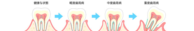 歯周病の進行図